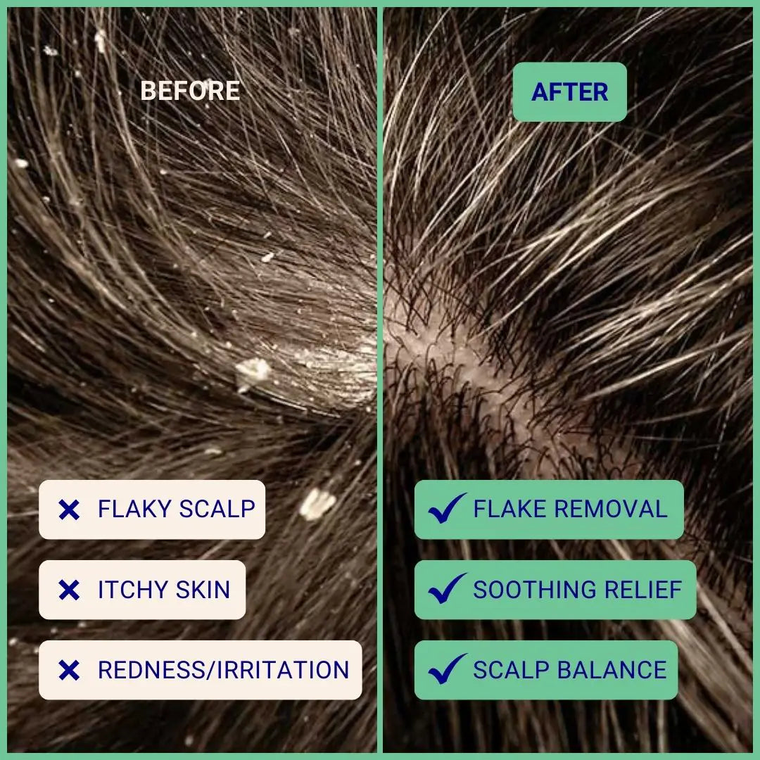 Exfoliating Shampoo For Loose Dandruff Flakes Tea Tree & Salicylic Acid 20g / 0.70oz