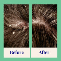 Exfoliating Shampoo For Loose Dandruff Flakes Tea Tree & Salicylic Acid 20g / 0.70oz